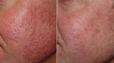 Entfernung eines geplatzten Äderchens / einer geplatzten Vene