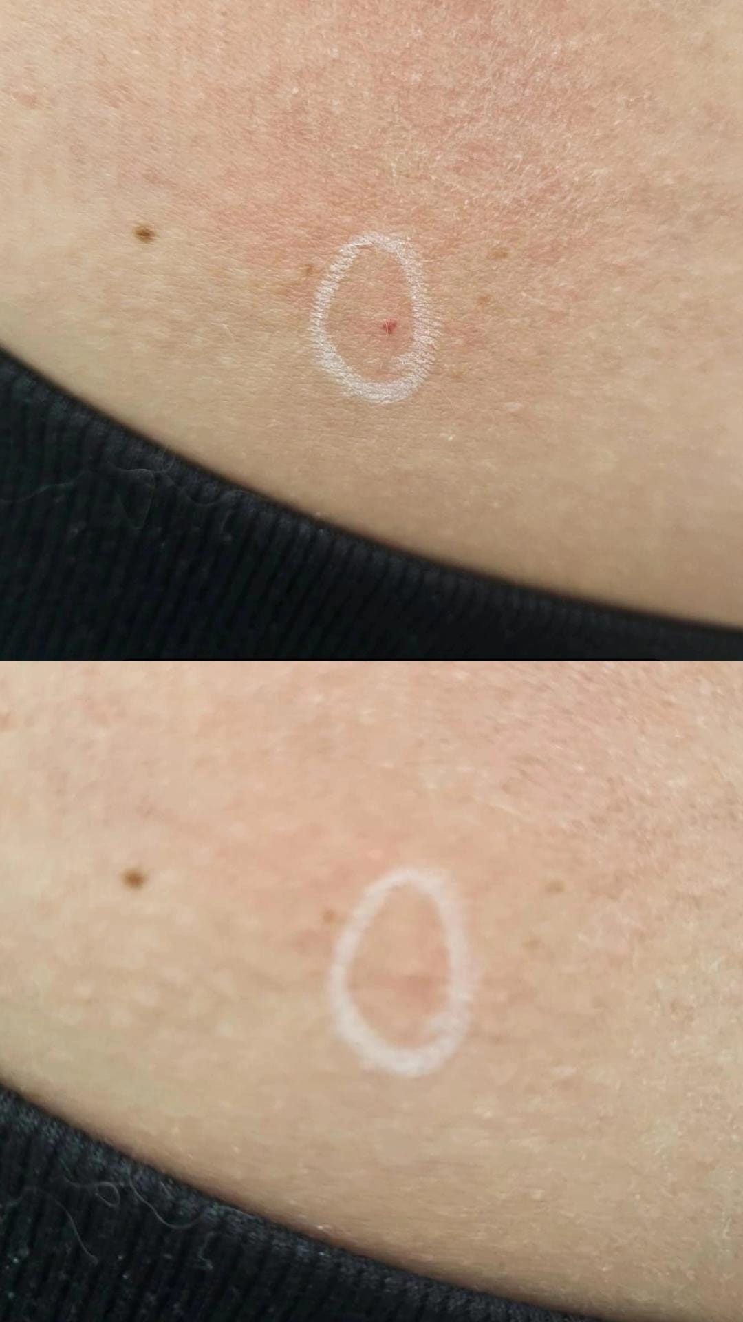 Entfernung von Kirschangiomen