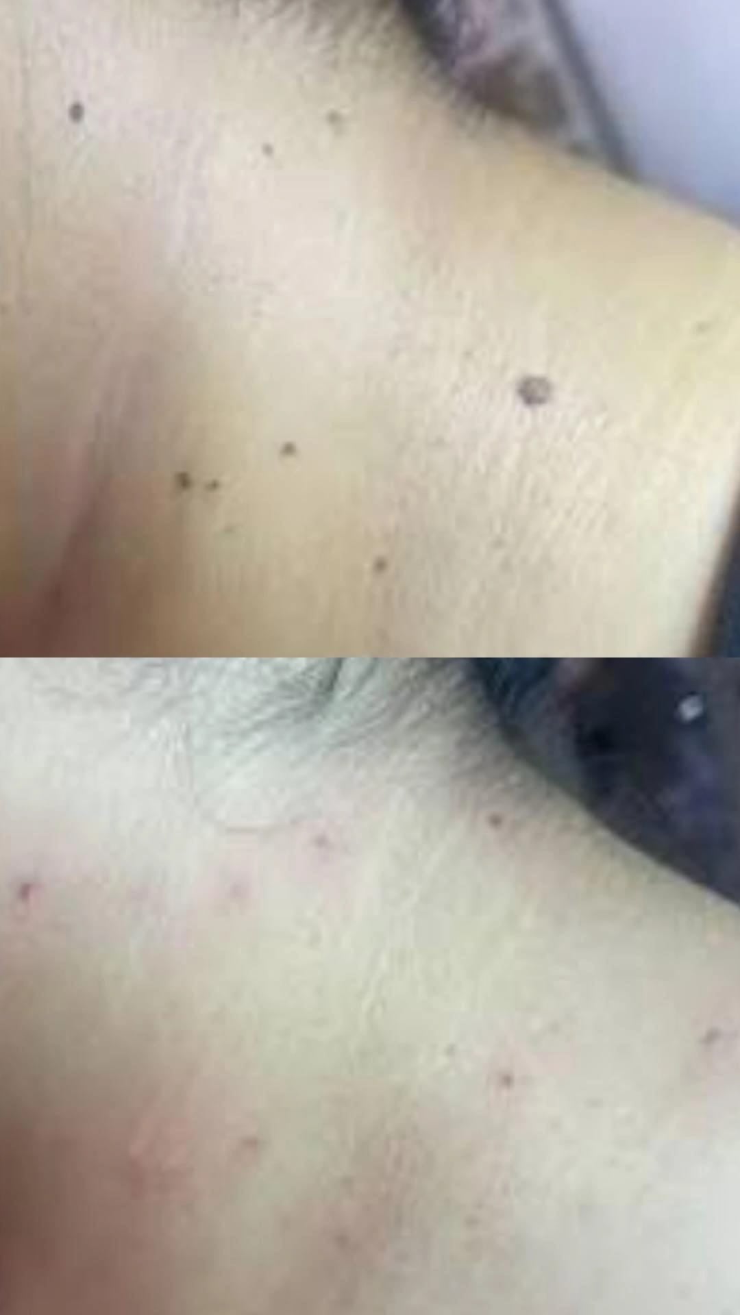 Entfernung gutartiger Hautläsionen