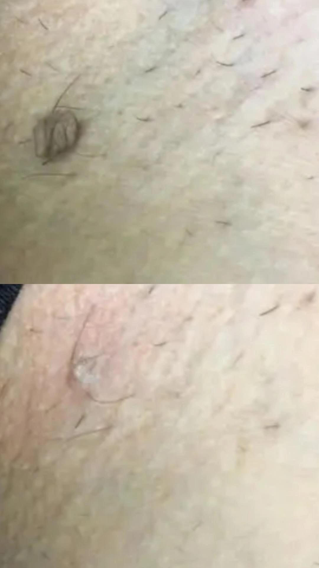 Entfernung gutartiger Hautläsionen