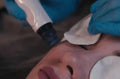 Hydrafacial