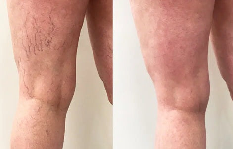 Entfernung eines geplatzten Äderchens / einer geplatzten Vene