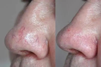 Entfernung eines geplatzten Äderchens / einer geplatzten Vene